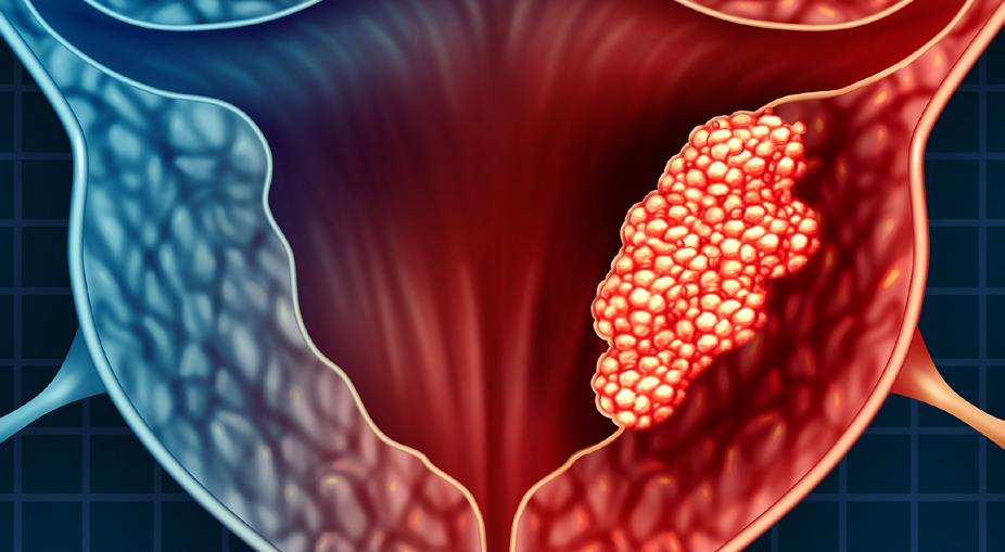 Bleeding After Menopause Could Be a Sign of Endometrial Cancer Bleeding After Menopause Could Be a Sign of Endometrial Cancer