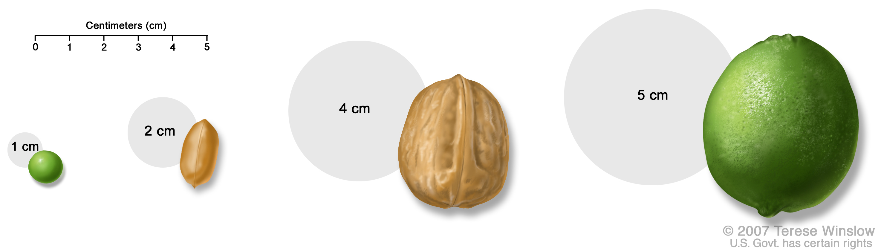 Tumor size compared to everyday objects; shows various measurements of a tumor compared to a pea, peanut, walnut, and lime