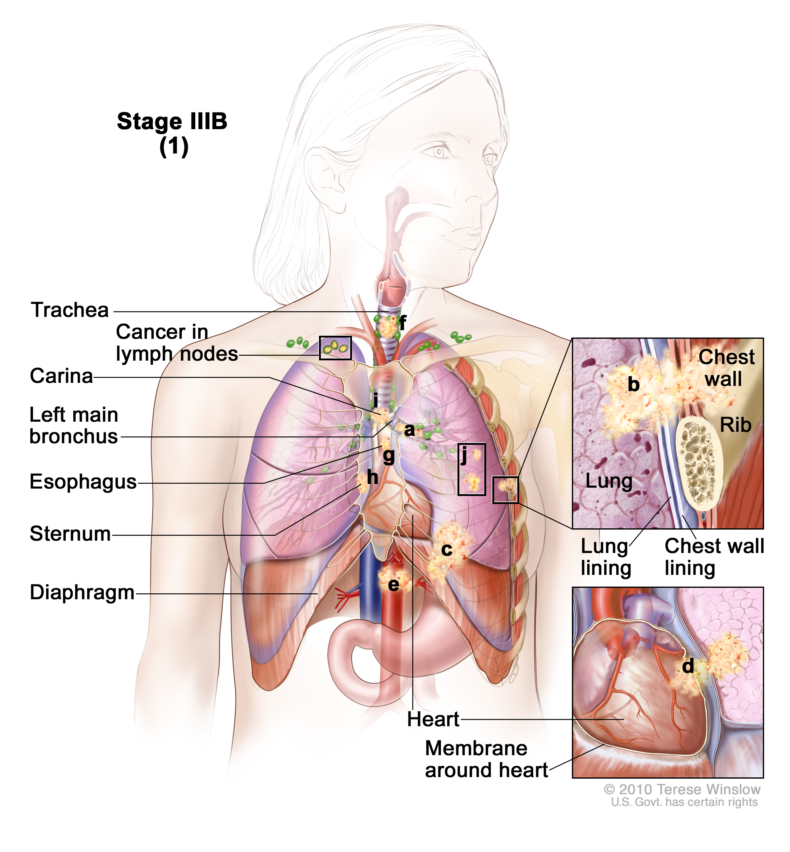 Stage IIIB non-small cell lung cancer (1). Drawing shows cancer in lymph nodes above the collarbone on the opposite side of the chest as the primary tumor, and in the trachea, carina, left main bronchus, esophagus, sternum, diaphragm, and major blood vessels that lead to or from the heart; there may be separate tumors in the same lung. Top inset shows cancer that has spread from the lung, through the lung lining and chest wall lining, into the chest wall; a rib is also shown. Bottom inset shows cancer that has spread from the lung, through the membrane around the heart, into the heart.