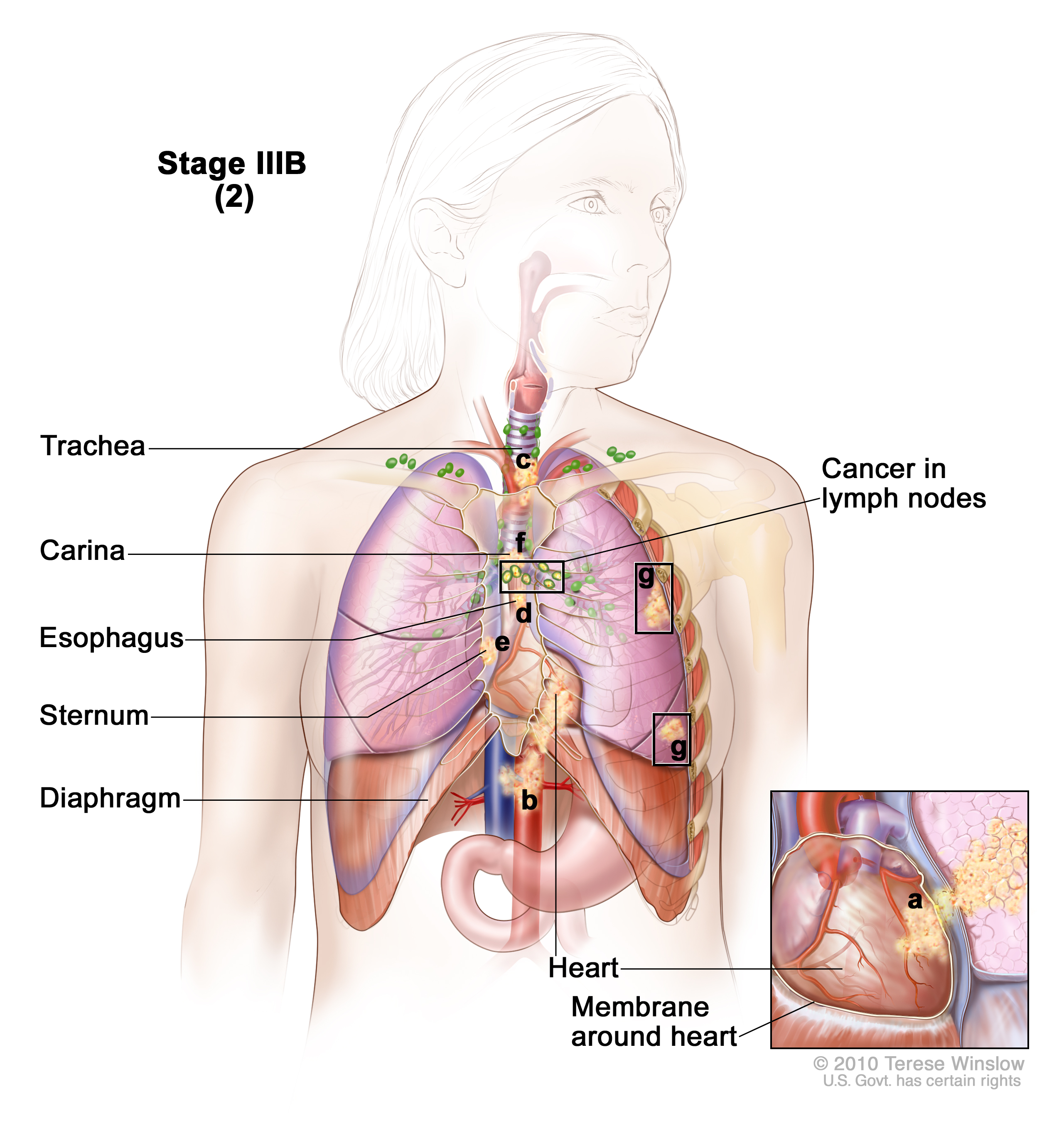 Stage IIIB non-small cell lung cancer (2). Drawing shows cancer in lymph nodes on the same side of the chest as the primary tumor, in the heart, major blood vessels that lead to or from the heart, the trachea, esophagus, sternum, carina, and in separate tumors in different lobes of the same lung; the diaphragm is also shown. Inset shows cancer that has spread from the lung, through the membrane around the heart, into the heart.